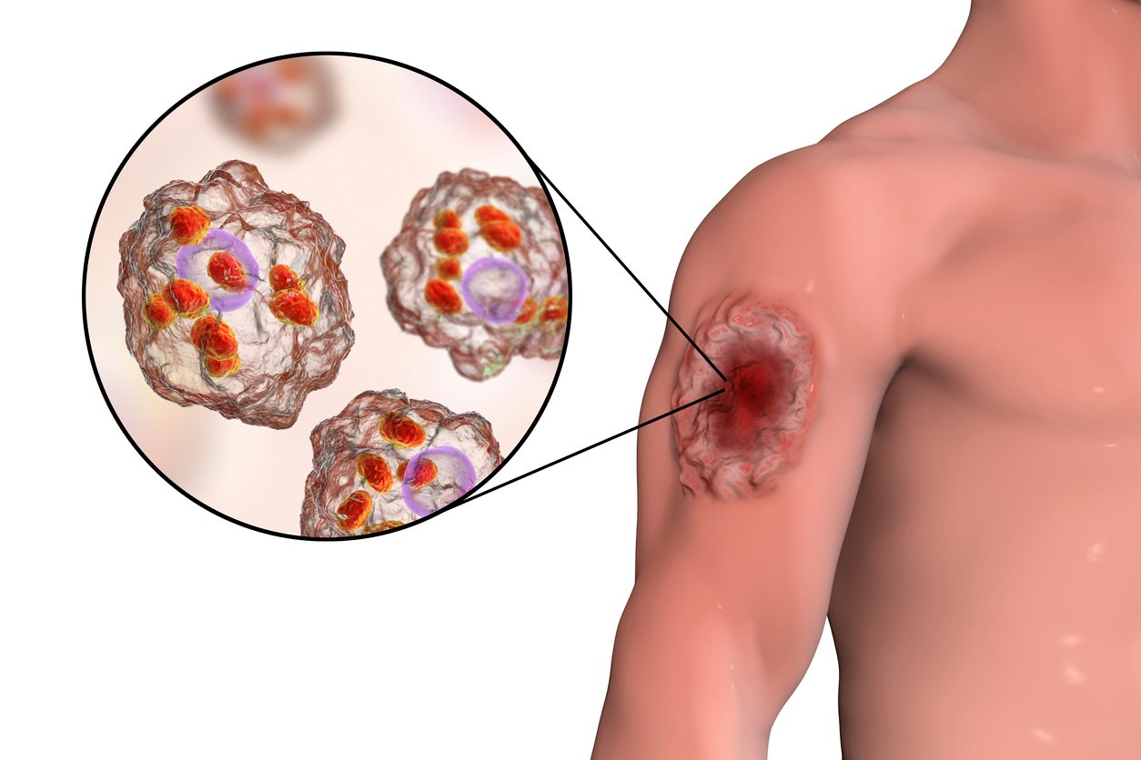 Cutaneous leishmaniasis ulcer and close-up view of Leishmania amastigotes, iStock-695604638