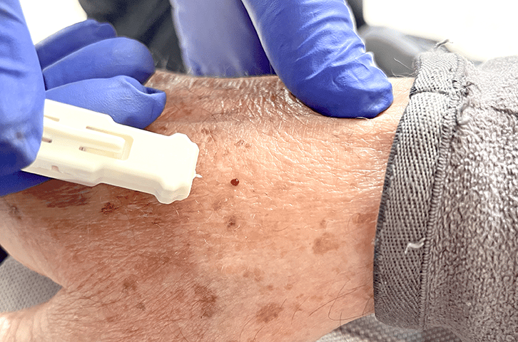 Harpera tool used on an elderly persons hand to take a micro skin sample