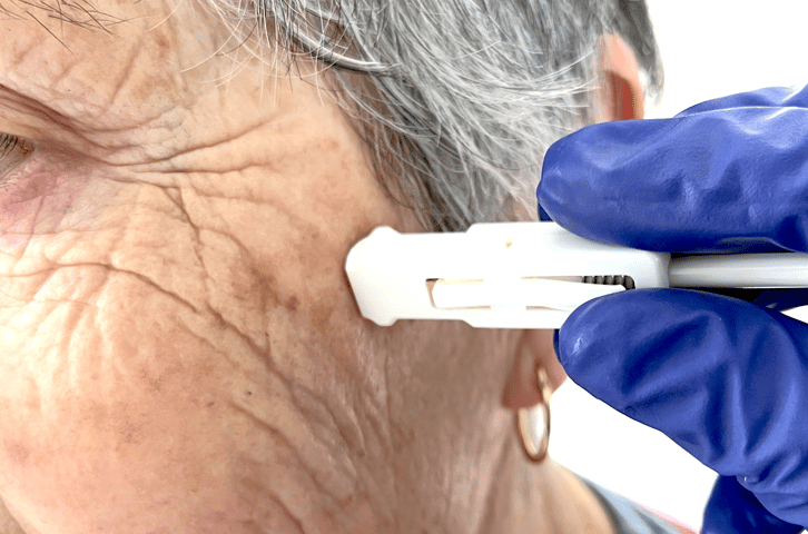 Harpera tool used on the side of the face to take a micro skin sample