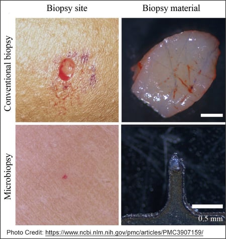 Side by side photos of a traditional skin biopsy punch wound versus a microbiopsy miniature skin prick wound 