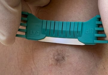 Shave Biopsy