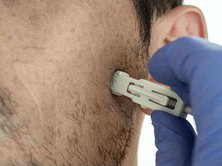the harpera punch biopsy tool taking a micro skin sample from mans cheek