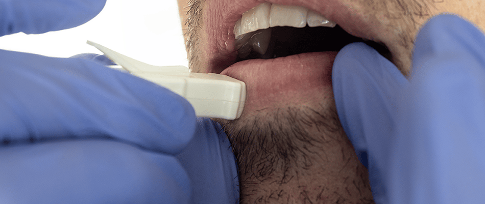 Close up photo of a researcher taking a micro skin sample from a mans lower lip region
