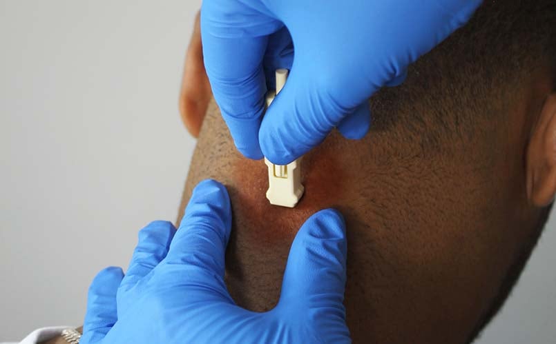 inflamatory-skin-disease-gentle-skin-biopsy