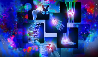 rheumatoid arthritis-iStock-1314538530