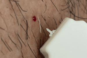 scarless-micro-biospy-sample-collection_m