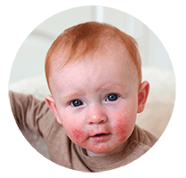 headshot of an infant with a skin infection