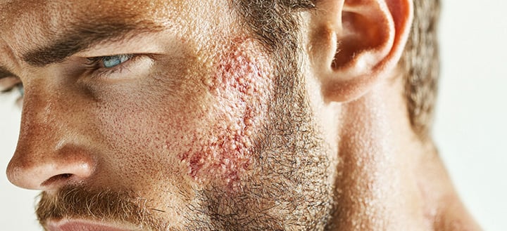 Microsampling Blog | Neoteryx | Skin Microsampling, Microbiopsy