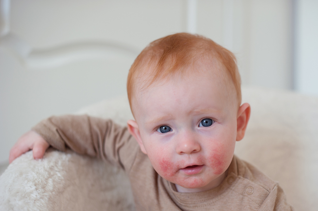 atopic dermatitis study in infants