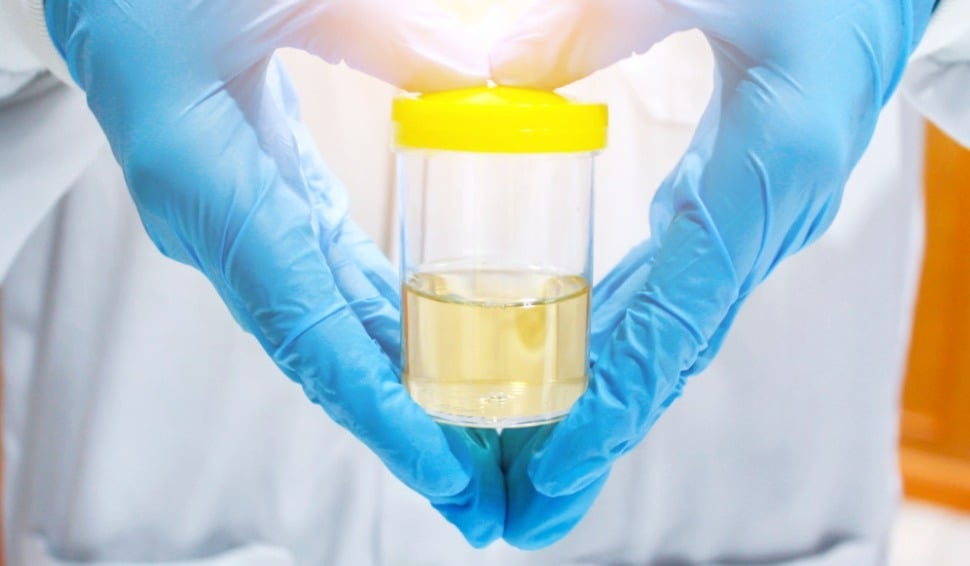 dried urine samples more stable than liquid samples