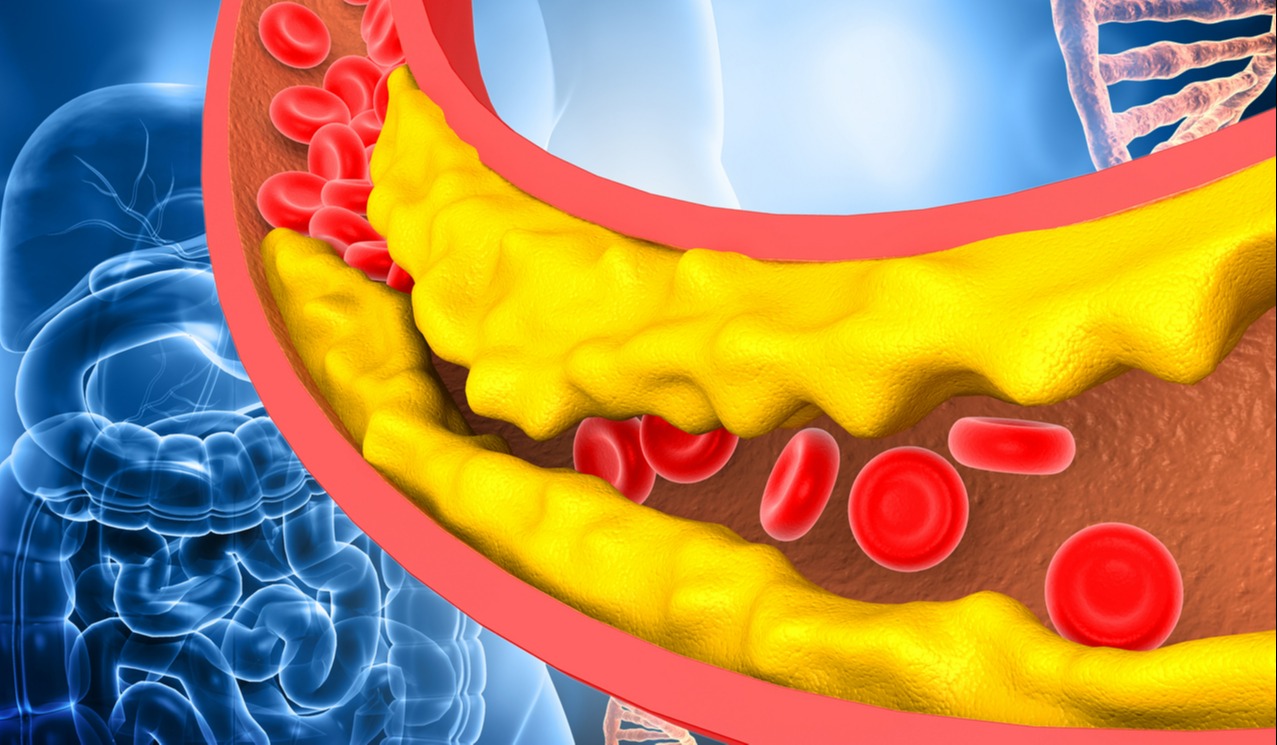 rosuvastatin lowers cholesterol in arteries